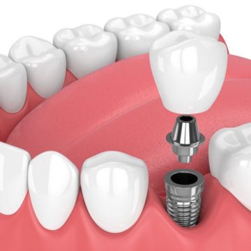 implant dental procedure Имплантация зубов в Киеве
