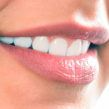 ceramic-veneers-smile Установка керамических виниров в Киеве